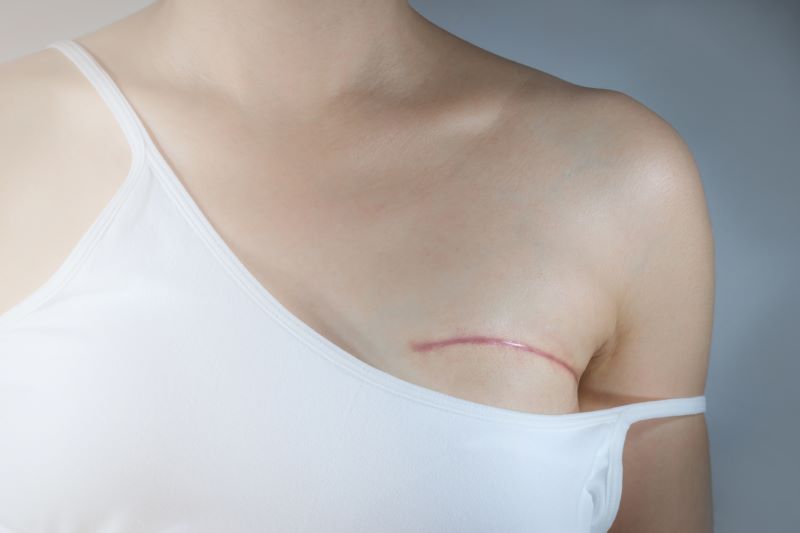 How Can Women Maintain Body Confidence and a Healthy Sexual Relationship After Mastectomy?